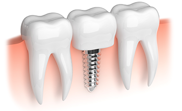 Dental implants